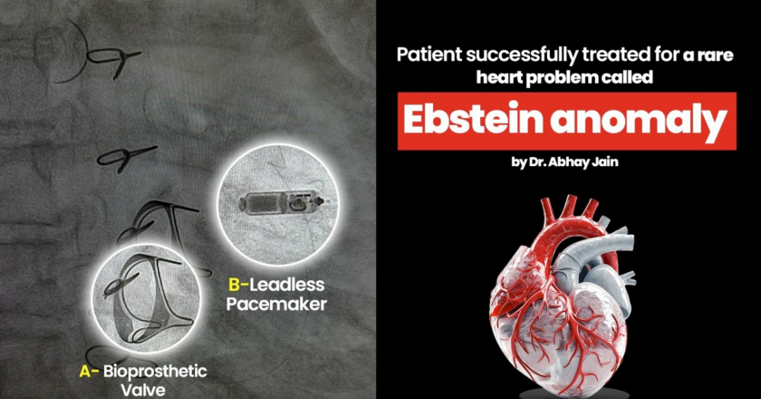 Patient successfully treated for a rare heart problem called Ebstein anomaly by Dr. Abhay Jain